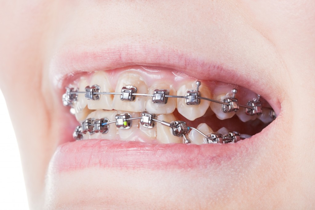 kids teeth with braces