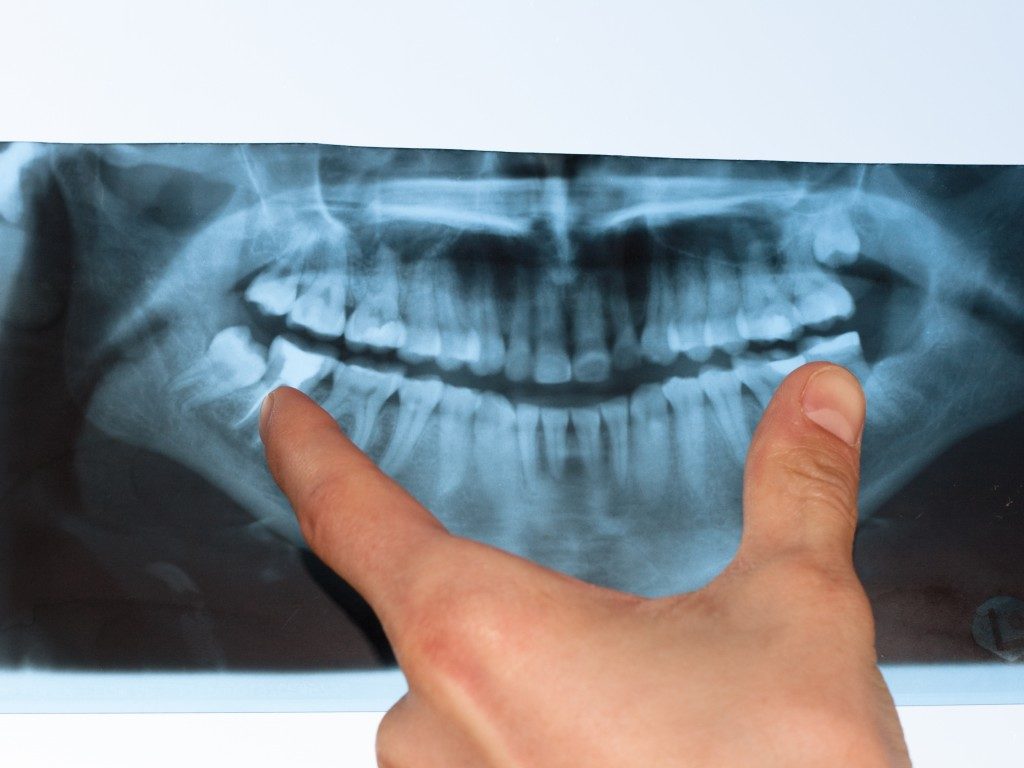 impacted wisdom teeth