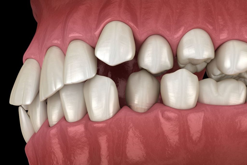 misaligned teeth