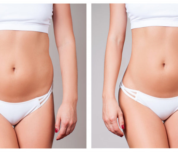 Body Contouring Technologies: Beyond the Gym