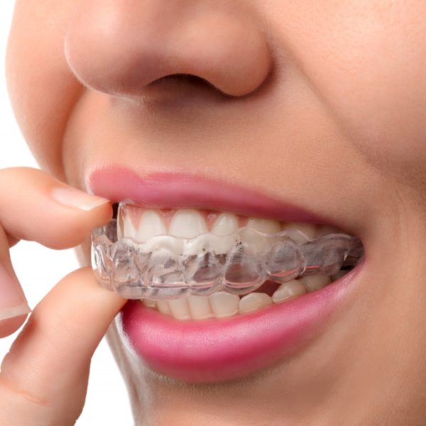 invisalign